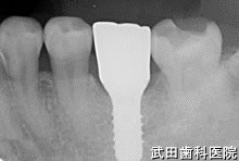 府中市の歯医者 口腔外科専門医　武田歯科のインプラント事例【左下6】術後3年経過

