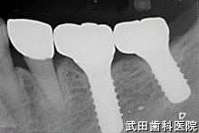 府中市の歯医者 口腔外科専門医　武田歯科のインプラント事例【左下67】上部構造装着
