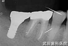 府中市の歯医者 口腔外科専門医　武田歯科のインプラント事例【右下7】上部構造装着
