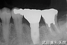 府中市の歯医者 口腔外科専門医　武田歯科のインプラント事例【左下6（抜歯即時埋入）】上部構造装着
