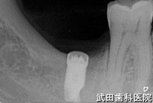 府中市の歯医者 口腔外科専門医　武田歯科のインプラント事例【右下7】インプラント埋入
