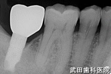 府中市の歯医者 口腔外科専門医　武田歯科のインプラント事例【右下7】術後3年経過
