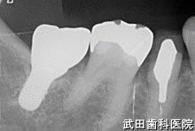 府中市の歯医者 口腔外科専門医　武田歯科のインプラント事例【右下7】術後3年経過
