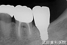 府中市の歯医者 口腔外科専門医　武田歯科のインプラント事例【左下7】上部構造装着
