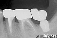 府中市の歯医者 口腔外科専門医　武田歯科のインプラント事例【左下7（ショートインプラント）】上部構造装着

