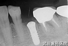 府中市の歯医者 口腔外科専門医　武田歯科のインプラント事例【左下5】インプラント埋入
