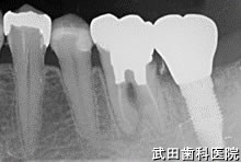 府中市の歯医者 口腔外科専門医　武田歯科のインプラント事例【左下7（抜歯即時埋入）】上部構造装着

