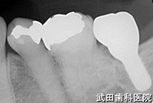 府中市の歯医者 口腔外科専門医　武田歯科のインプラント事例【左下7】術後3年経過
