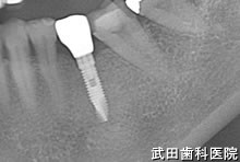 府中市の歯医者 口腔外科専門医　武田歯科のインプラント事例【左下5】上部構造装着

