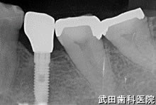 府中市の歯医者 口腔外科専門医　武田歯科のインプラント事例【左下5】術後3年経過
