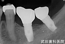 府中市の歯医者 口腔外科専門医　武田歯科のインプラント事例【左下67】術後2年経過
