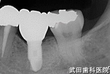 府中市の歯医者 口腔外科専門医　武田歯科のインプラント事例【左下6】術後4年経過

