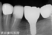 府中市の歯医者 口腔外科専門医　武田歯科のインプラント事例【左下6】上部構造装着
