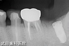 府中市の歯医者 口腔外科専門医　武田歯科のインプラント事例【左下7】インプラント埋入
