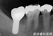 府中市の歯医者 口腔外科専門医　武田歯科のインプラント事例【右下7・左下7】上部構造装着
