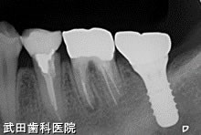 府中市の歯医者 口腔外科専門医　武田歯科のインプラント事例【右下7・左下7】上部構造装着
