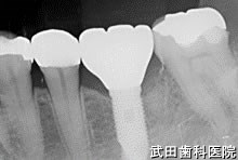 府中市の歯医者 口腔外科専門医　武田歯科のインプラント事例【右下6・左下6（抜歯即時埋入）】上部構造装置
