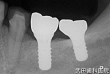 府中市の歯医者 口腔外科専門医　武田歯科のインプラント事例【左下67】上部構造装着
