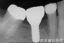 府中市の歯医者 口腔外科専門医　武田歯科のインプラント事例【左下6】上部構造装着
