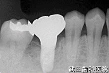 府中市の歯医者 口腔外科専門医　武田歯科のインプラント事例【右下6（抜歯即時埋入、下顎隆起応用）】上部構造装着

