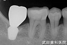府中市の歯医者 口腔外科専門医　武田歯科のインプラント事例【左下7】術後4年経過
