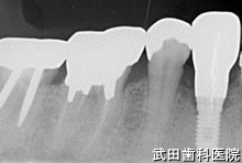 府中市の歯医者 口腔外科専門医　武田歯科のインプラント事例【右下4（スプリットクレストテクニック）】上部構造装着
