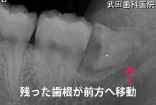 府中市の歯医者 武田歯科の親知らず2回法抜歯【左下8】治療1週間後