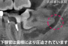 府中市の歯医者 武田歯科の親知らず2回法抜歯【左下8】CT画像
