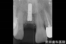 府中市の歯医者 口腔外科専門医　武田歯科のインプラント事例【右上1】インプラント埋入
