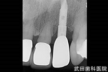 府中市の歯医者 口腔外科専門医　武田歯科のインプラント事例【右上2】上部構造装着
