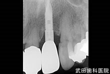 府中市の歯医者 口腔外科専門医　武田歯科のインプラント事例【右上2】術後3年経過

