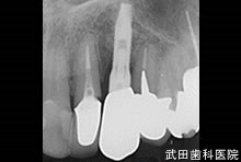 府中市の歯医者 口腔外科専門医　武田歯科のインプラント事例【左上3】上部構造装着
