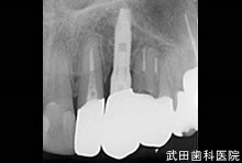 府中市の歯医者 口腔外科専門医　武田歯科のインプラント事例【左上1】術後2年経過
