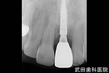 府中市の歯医者 口腔外科専門医　武田歯科のインプラント事例【左上1】上部構造装着
