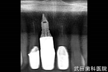 府中市の歯医者 口腔外科専門医　武田歯科のインプラント事例【右上1】上部構造装着
