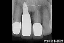 府中市の歯医者 口腔外科専門医　武田歯科のインプラント事例【右上1】術後5年経過
