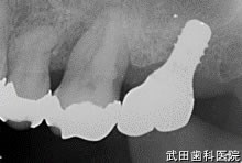 府中市の歯医者 口腔外科専門医　武田歯科のインプラント事例【右上7】上部構造装着
