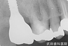府中市の歯医者 口腔外科専門医　武田歯科のインプラント事例【右上7】上部構造装着
