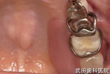 府中市の歯医者 口腔外科専門医　武田歯科のインプラント事例【左上6】義歯装着時
