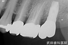 府中市の歯医者 口腔外科専門医　武田歯科のインプラント事例【左上7】上部構造装着
