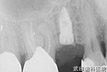 府中市の歯医者 口腔外科専門医　武田歯科のインプラント事例【右上5】インプラント埋入
