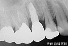 府中市の歯医者 口腔外科専門医　武田歯科のインプラント事例【右上5】上部構造装着
