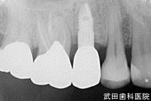 府中市の歯医者 口腔外科専門医　武田歯科のインプラント事例【右上5】術後3年経過
