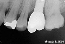 府中市の歯医者 口腔外科専門医　武田歯科のインプラント事例【左上6　歯周組織再生療法（ｴﾑﾄﾞｹﾞｲﾝ® ）併用】上部構造装着
