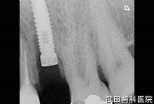 府中市の歯医者 口腔外科専門医　武田歯科のインプラント事例【左上5（抜歯即時埋入）】インプラント埋入
