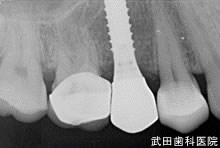 府中市の歯医者 口腔外科専門医　武田歯科のインプラント事例【右上5】上部構造装着
