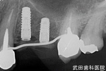 府中市の歯医者 口腔外科専門医　武田歯科のインプラント事例【左上45】インプラント埋入
