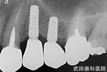府中市の歯医者 口腔外科専門医　武田歯科のインプラント事例【左上45】上部構造装着
