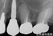 府中市の歯医者 口腔外科専門医　武田歯科のインプラント事例【右上4】上部構造装着
