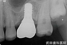 府中市の歯医者 口腔外科専門医　武田歯科のインプラント事例【左上6】上部構造装着
